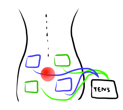 How did Ye Olde Blogge use a TENS Unit to get through the Insurrection and Cambodian Genocide anniversaries?