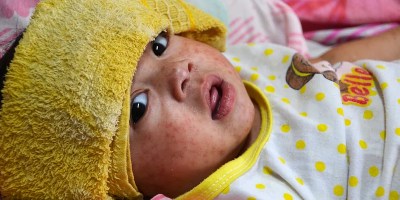 Shows a young baby, maybe a year old, with a measles rash across its flushed cheeks and a yellow towel across its forehead.