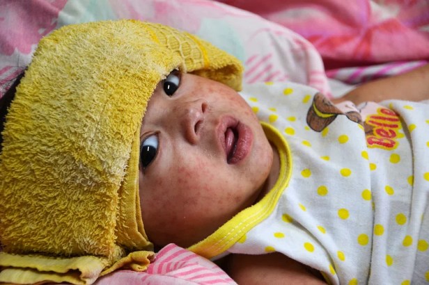 Shows a young baby, maybe a year old, with a measles rash across its flushed cheeks and a yellow towel across its forehead.